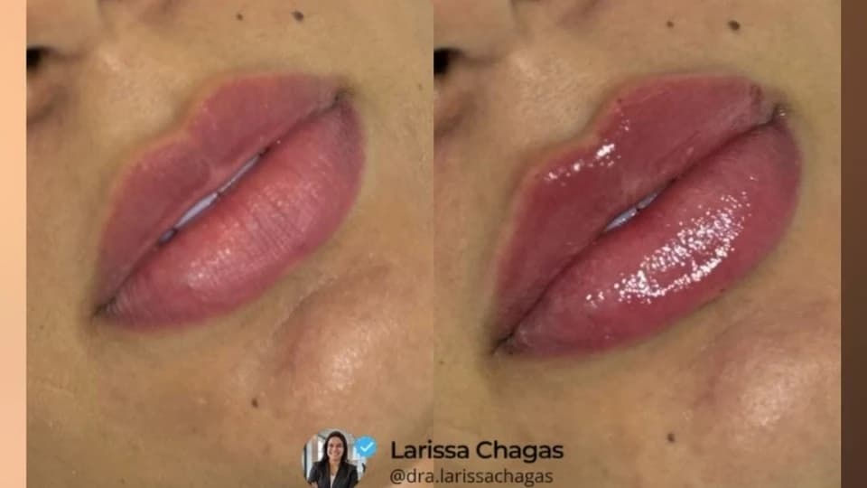 Dra. Larissa Chagas - Harmonização Facial e Corporal